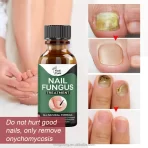 Prirodni Gel Protiv Gljivica na Noktima – Fungal Restore Gel za Negu Stopala i Noktiju (10ml) - Image 2