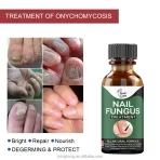 Prirodni Gel Protiv Gljivica na Noktima – Fungal Restore Gel za Negu Stopala i Noktiju (10ml) - Image 4